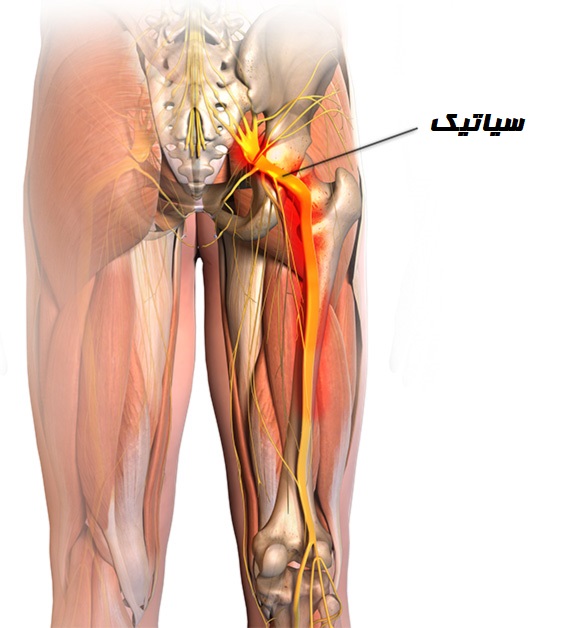3 روش درمان خانگی سیاتیک موثر و کاربردی