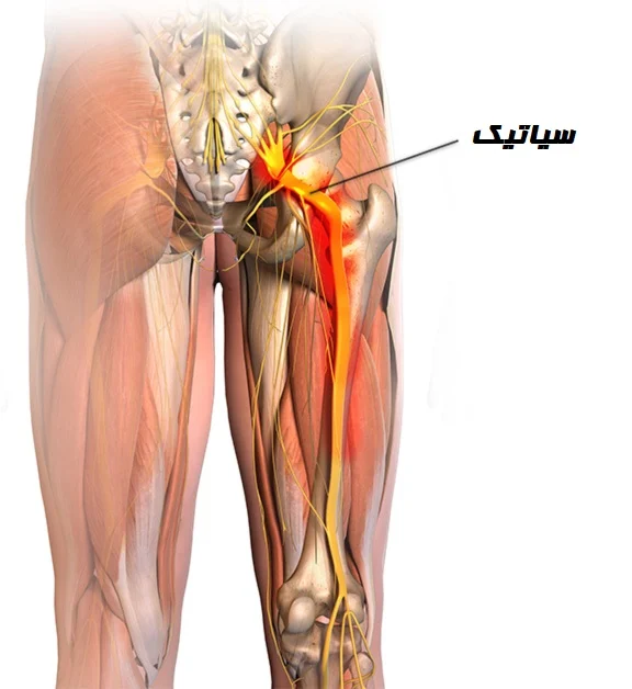 3 روش درمان خانگی سیاتیک موثر و کاربردی