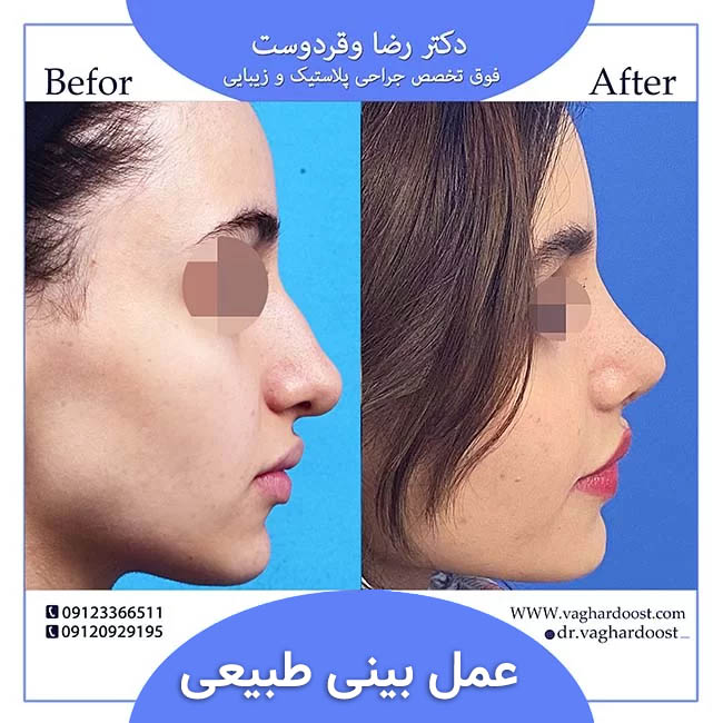 جراحی بینی طبیعی را کجا انجام دهیم؟