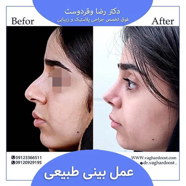 جراحی | جراحی بینی جراحی بینی طبیعی را کجا انجام دهیم؟