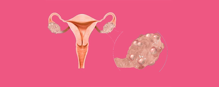 برای تقویت تنبلی تخمدان و بارداری سریع چه بخوریم؟