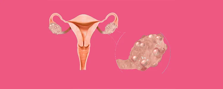 برای تقویت تنبلی تخمدان و بارداری سریع چه بخوریم؟