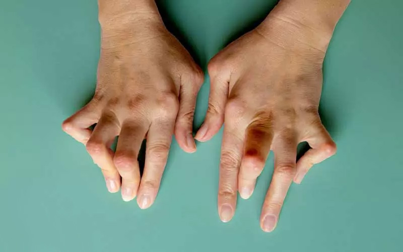 تاثیر بیماری های التهابی مانند روماتیسم بر درد بند انگشتان