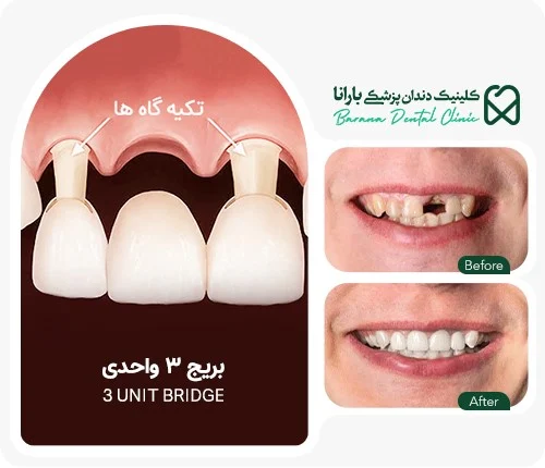بریج دندان